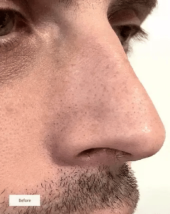 Hydrocolloid Overnight Nose Patches
