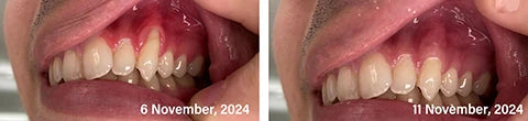 Bee Venom Toothpaste for Sensitive Gums