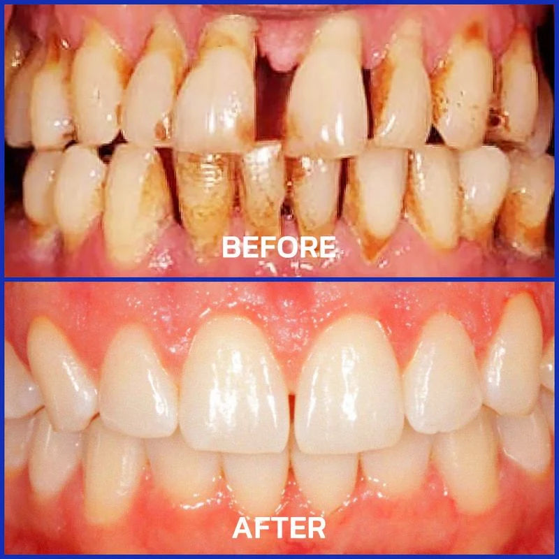 Bee Venom Toothpaste for Sensitive Gums