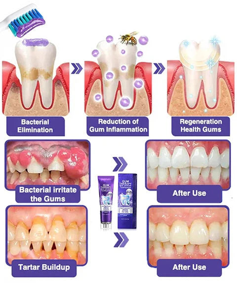 Bee Venom Toothpaste for Sensitive Gums