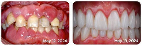 Bee Venom Toothpaste for Sensitive Gums