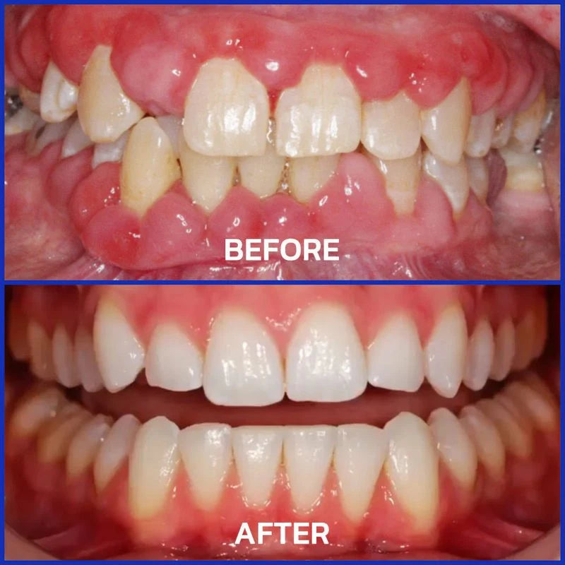 Bee Venom Toothpaste for Sensitive Gums